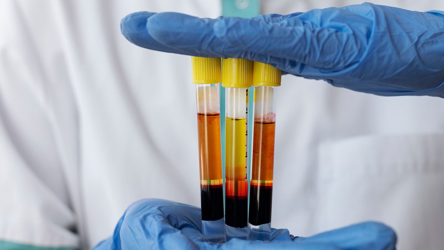 Le PRP est-il adapté à tous les types de perte de cheveux ?