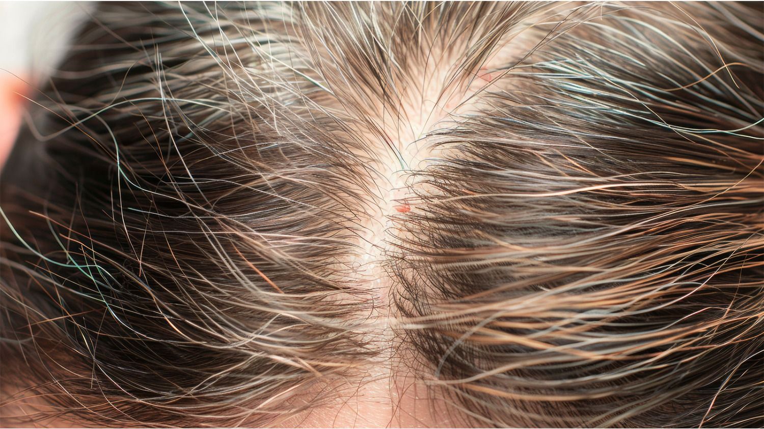 Androgenetic alopecia: what treatments are available to slow hair loss and promote regrowth?