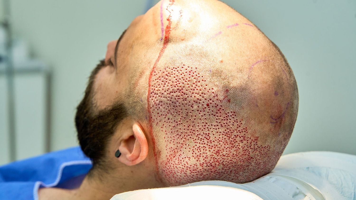 Failed hair transplant: how to recognize it and what to do?
