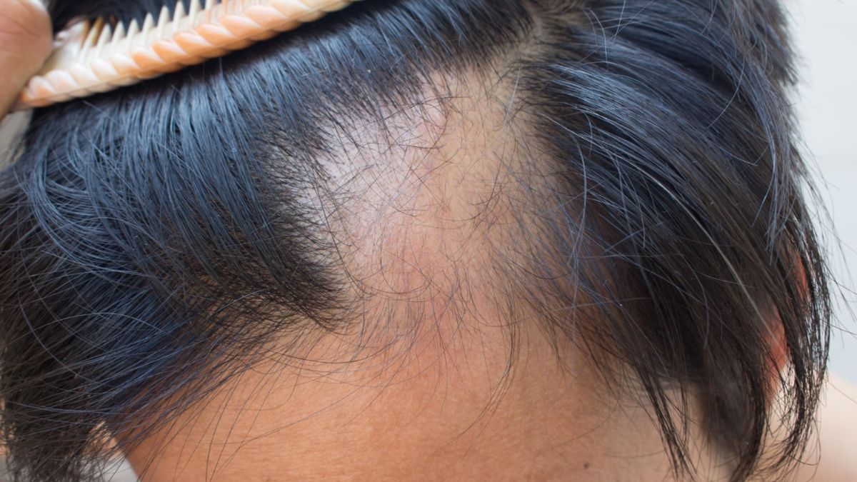 Alopecia Areata (Pelade) : causes, symptômes et traitements