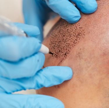 QUELLES SONT LES INDICATIONS POURLA GREFFE DE CHEVEUX DE CAMOUFLAGE ?