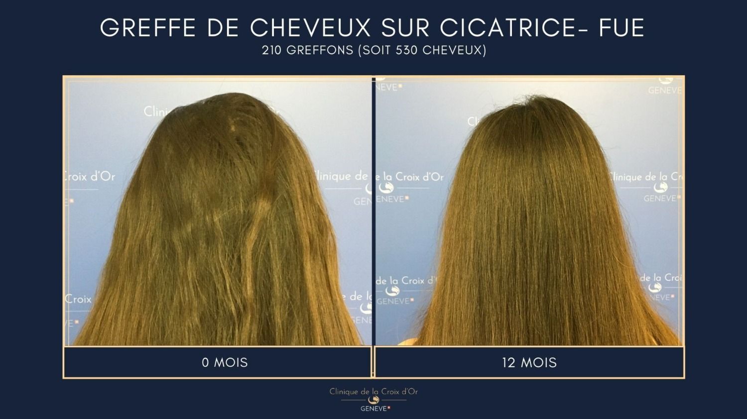 greffe_de_cheveux_femme_a_quel_age_quels_resultats_avant_apres_et_a_quel_prix_