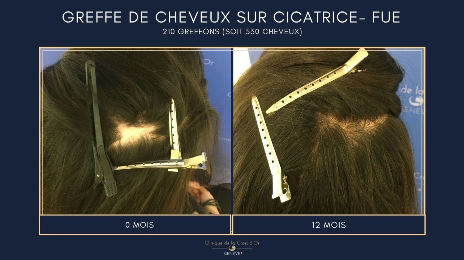 greffe_de_cheveux_femme_a_quel_age_quels_resultats_avant_apres_et_a_quel_prix_