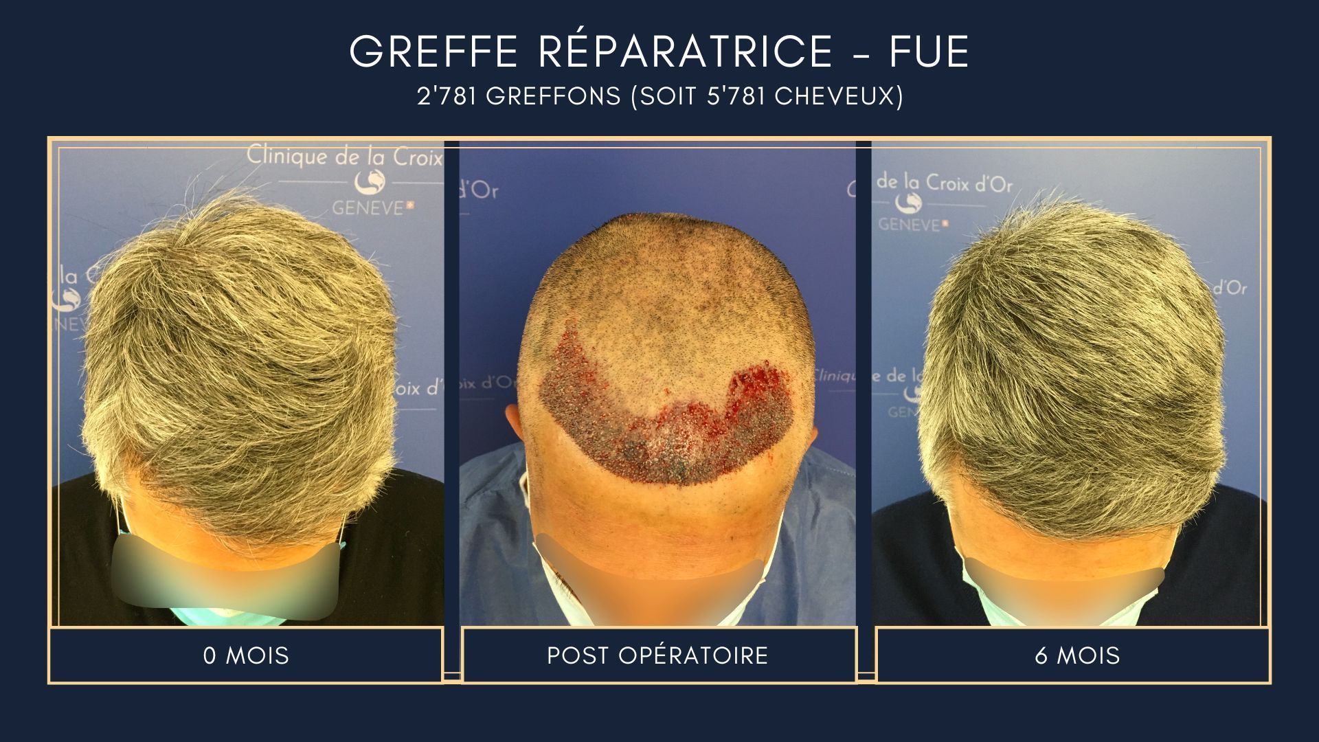 Reparative or corrective hair transplant