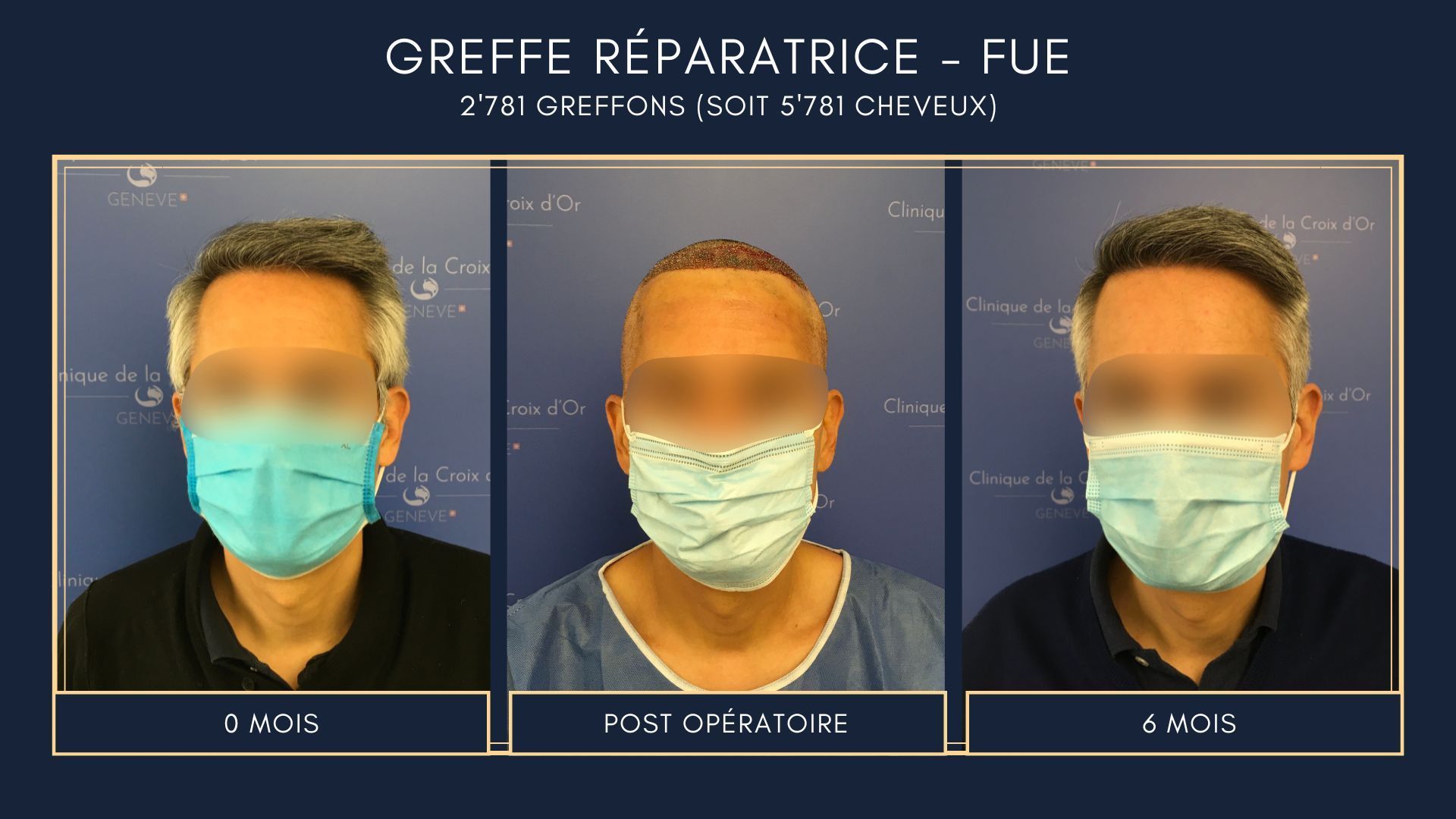 Reparative or corrective hair transplant