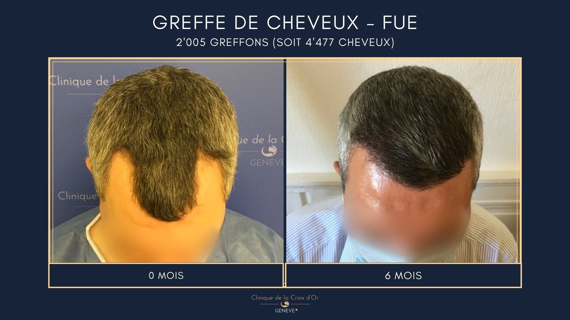 Hair Transplant - FUE