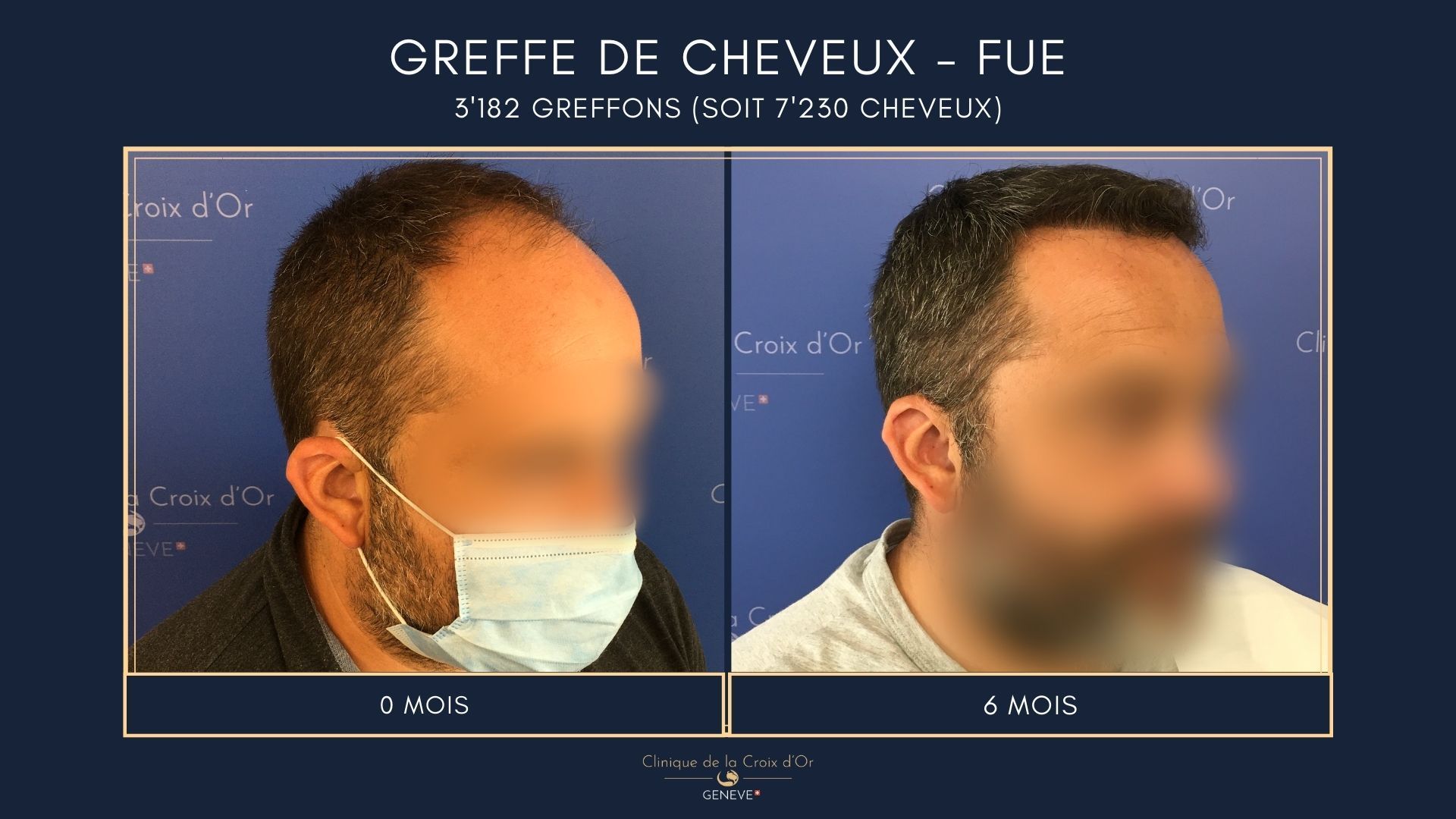 Hair Transplant - FUE